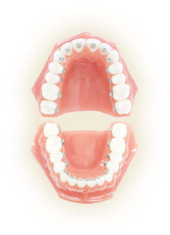 裏側矯正(リンガル矯正)